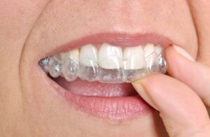 Dental Invisalign in Saddle Brook