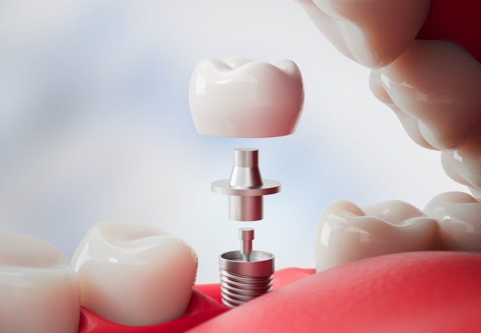 Natural Looking Dental Implants Clifton, NJ