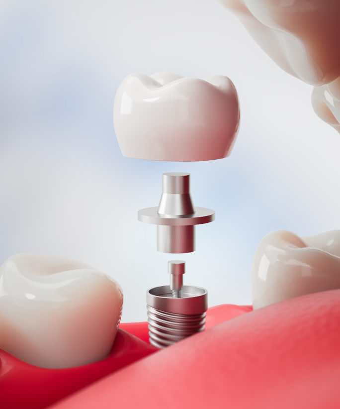 Full Mouth Dental Implants Hackensack, NJ