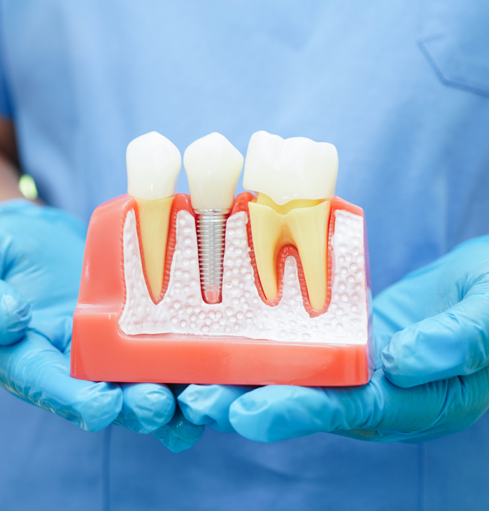 Implant Supported Crowns Maywood, NJ