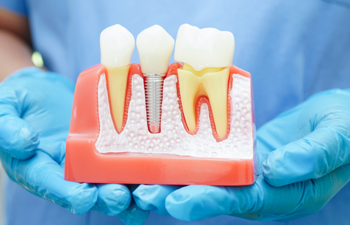 Missing Tooth Replacement Ridgewood, NJ Missing Tooth Replacement Ridgewood, NJ