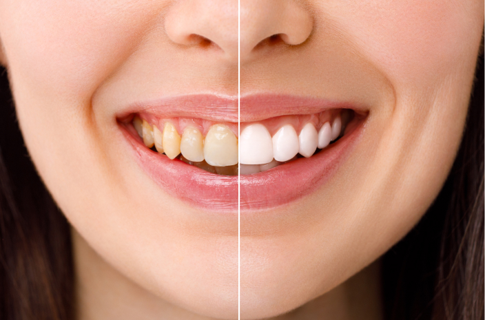 Professional Whitening Lodi, NJ Professional Whitening Lodi, NJ