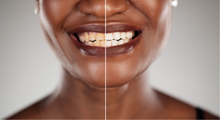 Custom Veneers Paramus, NJ
