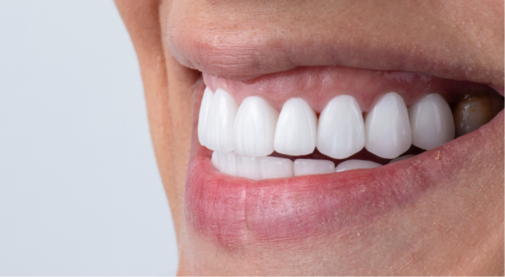 Dental Veneers Rochelle Park, NJ