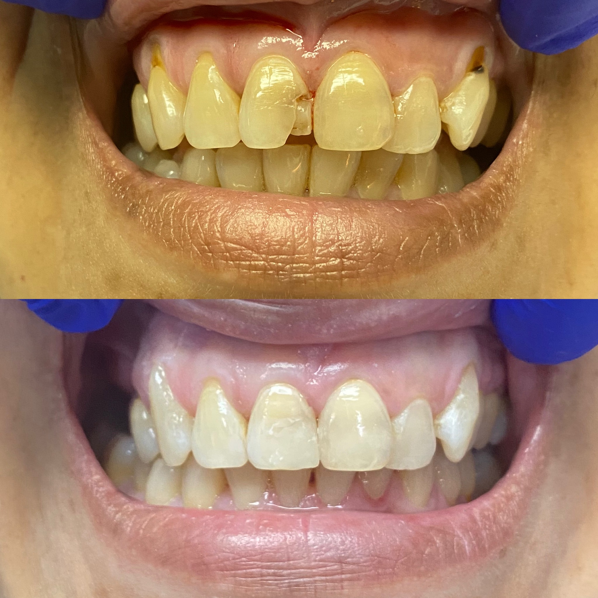 Dentistry Before and After Photos EverSmile Dental