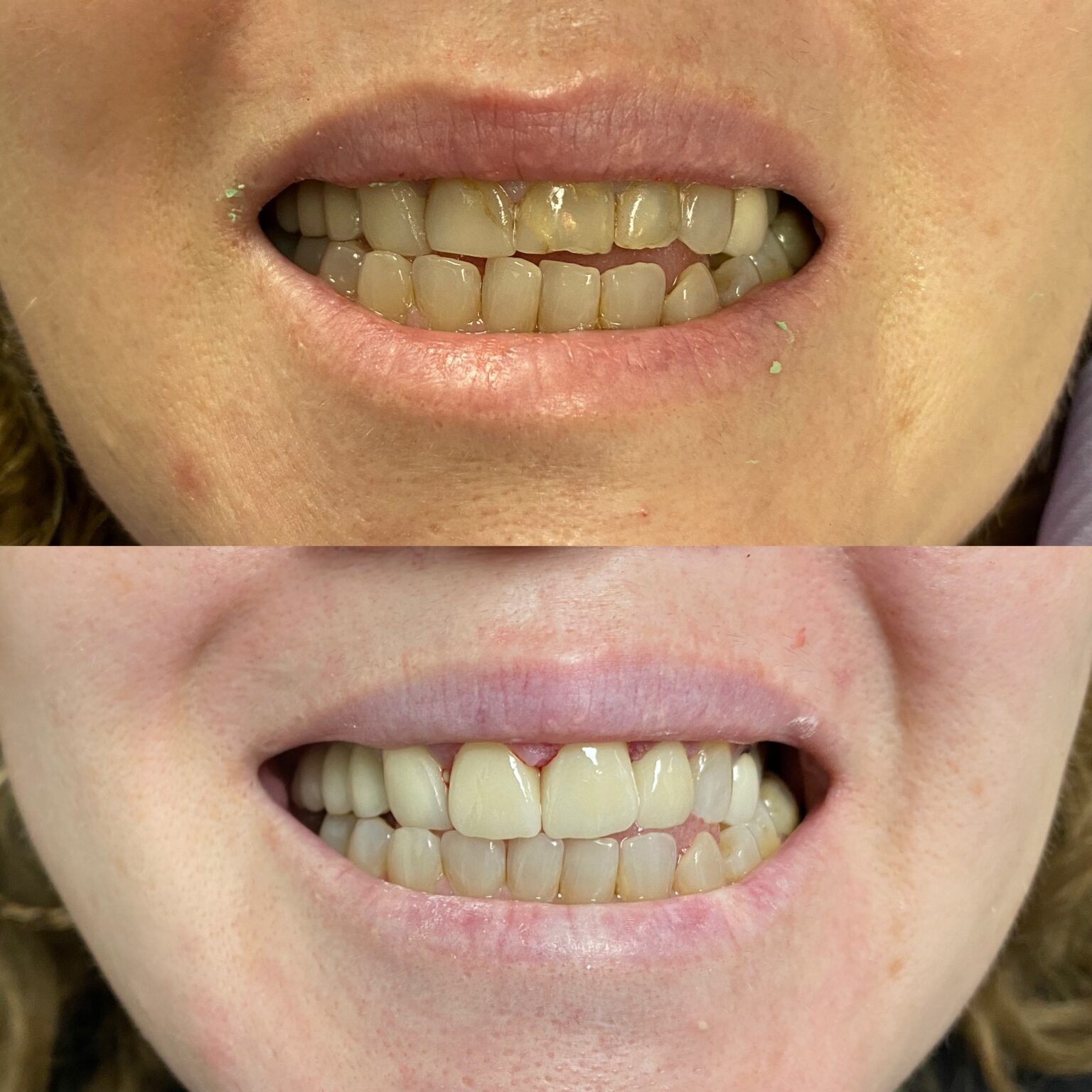 Dentistry Before and After Photos EverSmile Dental