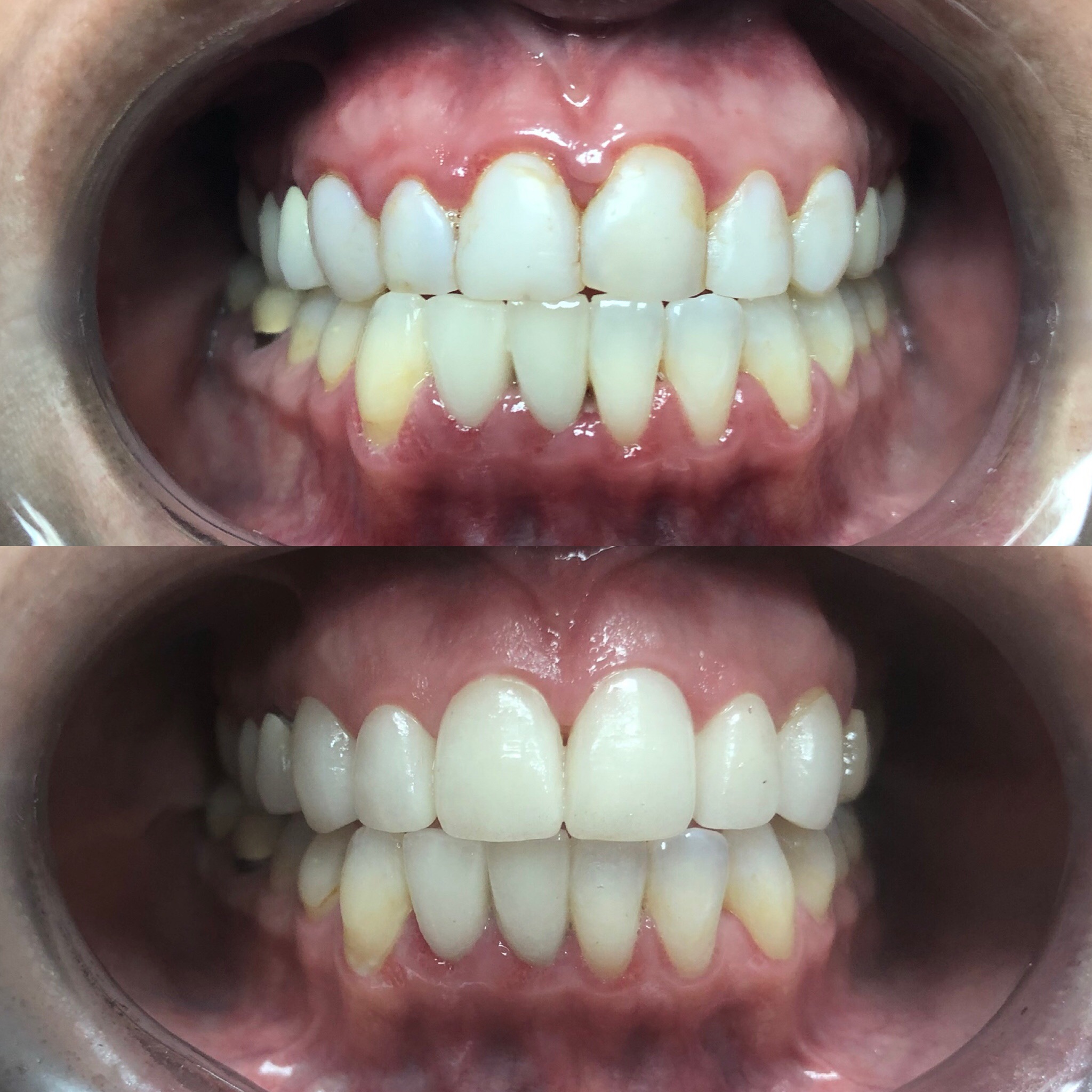 Dentistry Before and After Photos EverSmile Dental