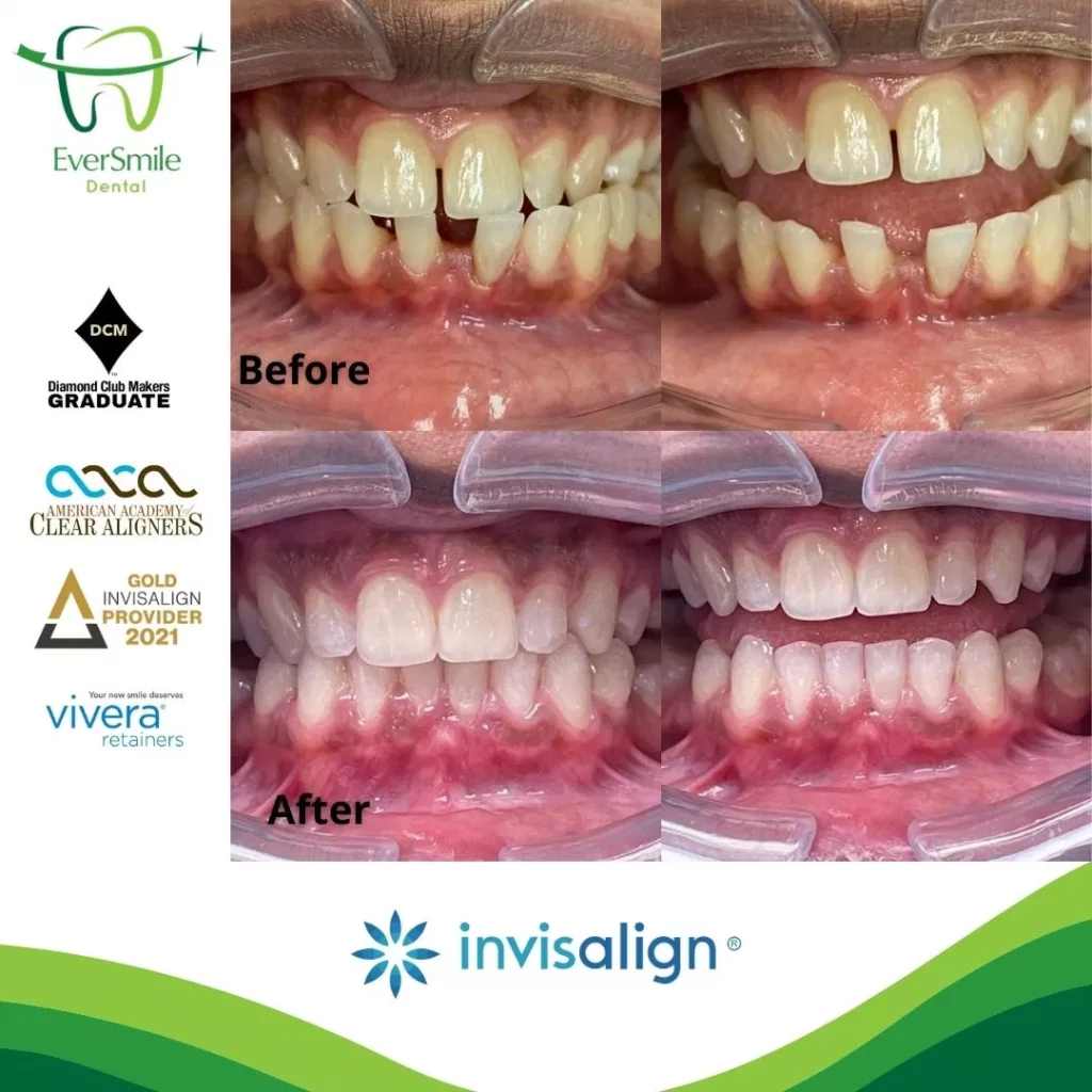 INVISALIGN BEFORE AND AFTER RESULTS - EVERSMILE DENTAL NJ