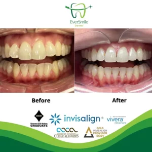 EverSmile Dental | Dental Bridges, ZOOM Whitening and Preventative Program