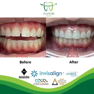 EverSmile Dental | Preventative Program, Cosmetic Dentistry and Pediatric Dentistry