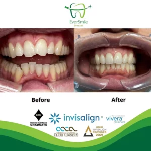 EverSmile Dental | Oral Exams, Crowns amp Caps and Dental Fillings