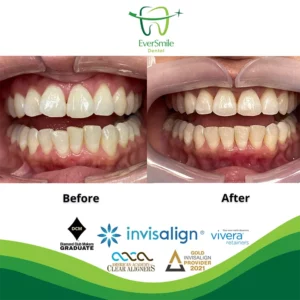 EverSmile Dental | Dental Bridges, Pediatric Dentistry and Night Guards