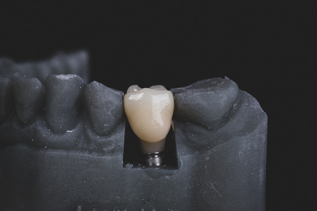 Dental Implants in Saddle Brook