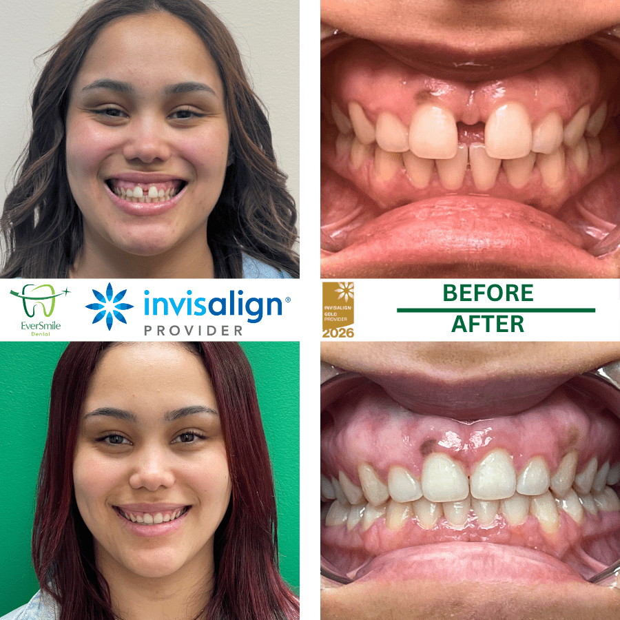 INVISALIGN BEFORE AND AFTER RESULTS - EVERSMILE DENTAL NJ