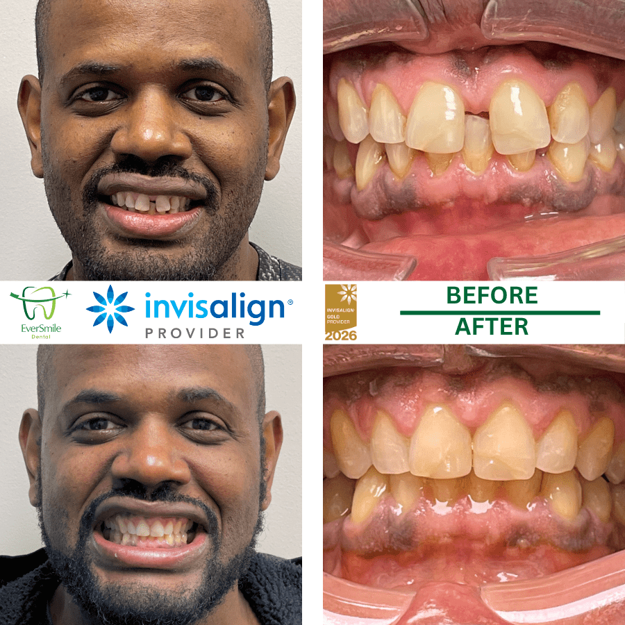 INVISALIGN BEFORE AND AFTER RESULTS - EVERSMILE DENTAL NJ