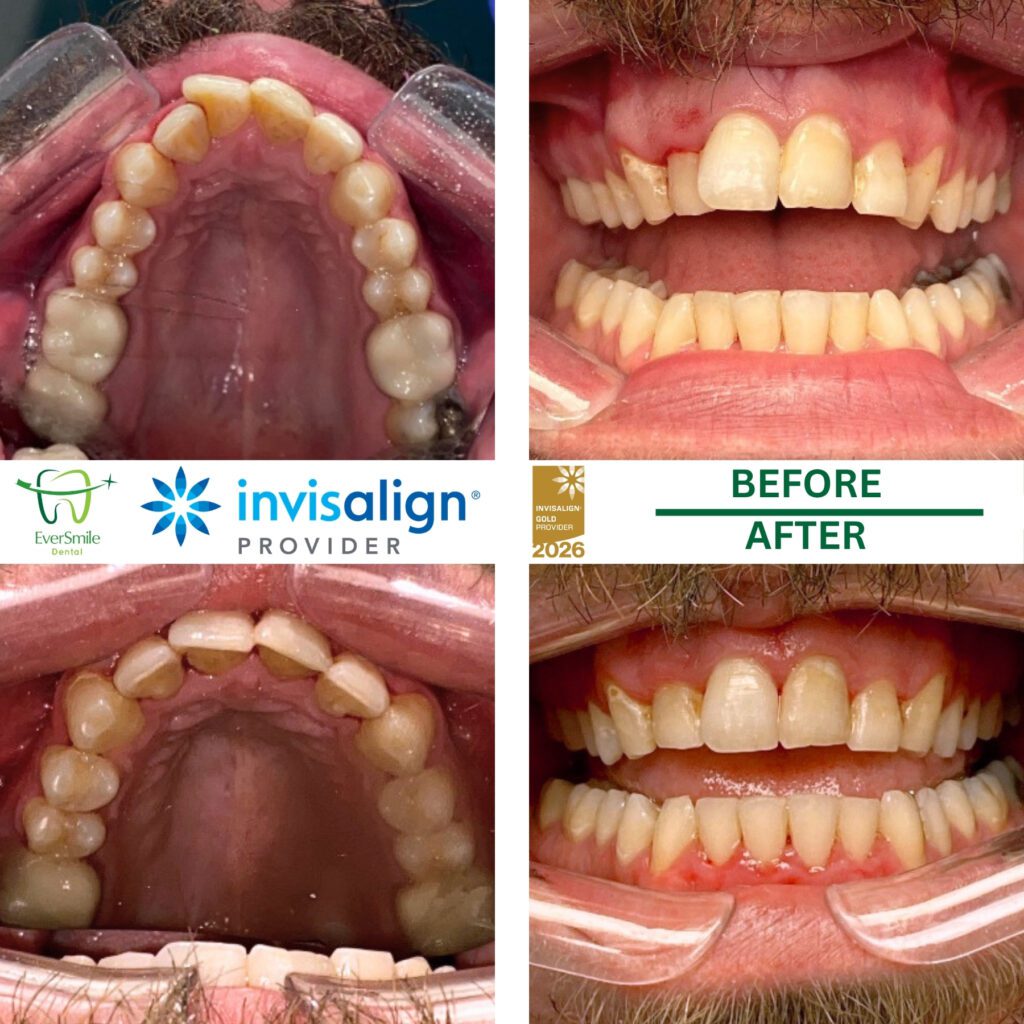INVISALIGN BEFORE AND AFTER RESULTS - EVERSMILE DENTAL NJ
