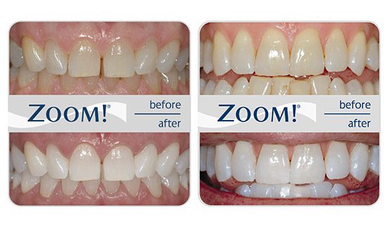 BEFORE AND AFTER ZOOM TEETH WHITENING RESULTS AT EVERSMILE DENTAL NJ