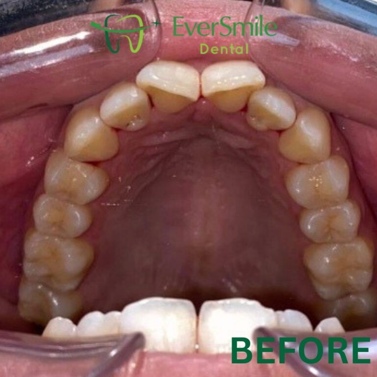 INVISALIGN 6 2 1