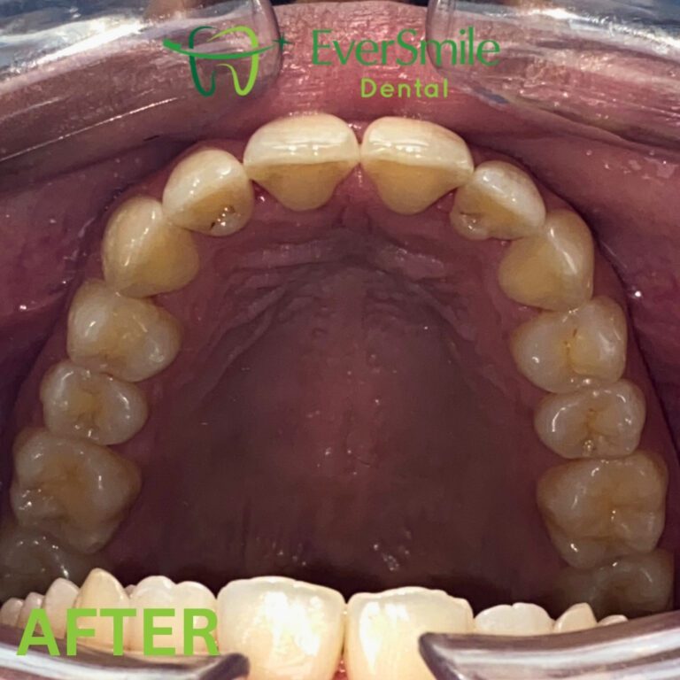 INVISALIGN 7 3 1