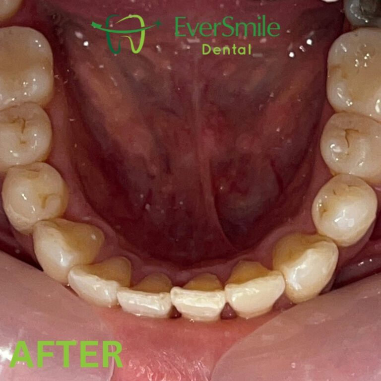 INVISALIGN 5 5 1
