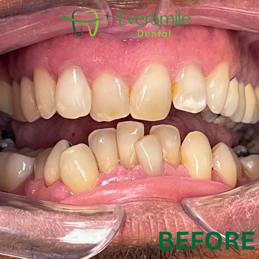 INVISALIGN CERTIFIED PROVIDER - EVERSMILE DENTAL NJ - BEFORE TREATMENT