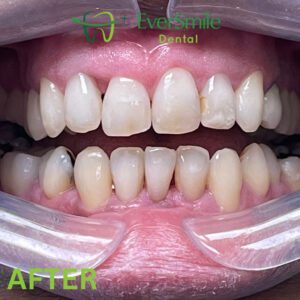 INVISALIGN CERTIFIED PROVIDER - EVERSMILE DENTAL NJ - AFTER TREATMENT