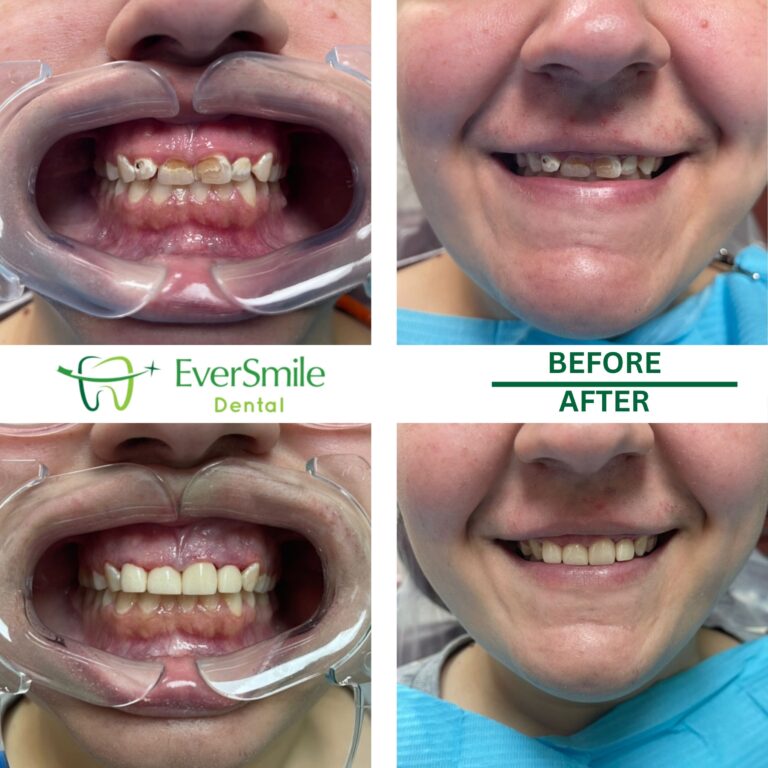 BEFORE AND AFTER PHOTOS OF PATIENT'S WORN, DISCOLORED TEETH RESTORED WITH DENTAL CROWNS AT EVERSMILE DENTAL, SHOWN IN CLOSE-UP AND FULL SMILE