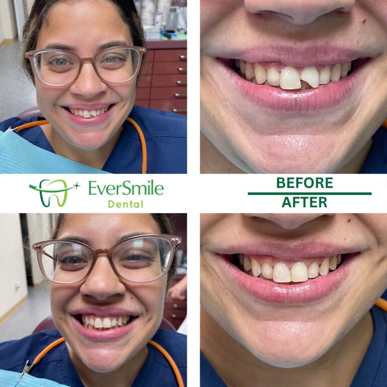 DENTAL FILLINGS 1 BONDING