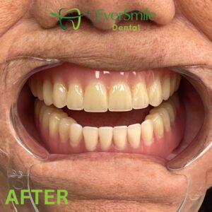 DENTURES AFTER SLIDER