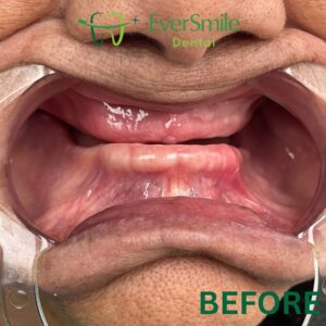 DENTURES BEFORE SLIDER