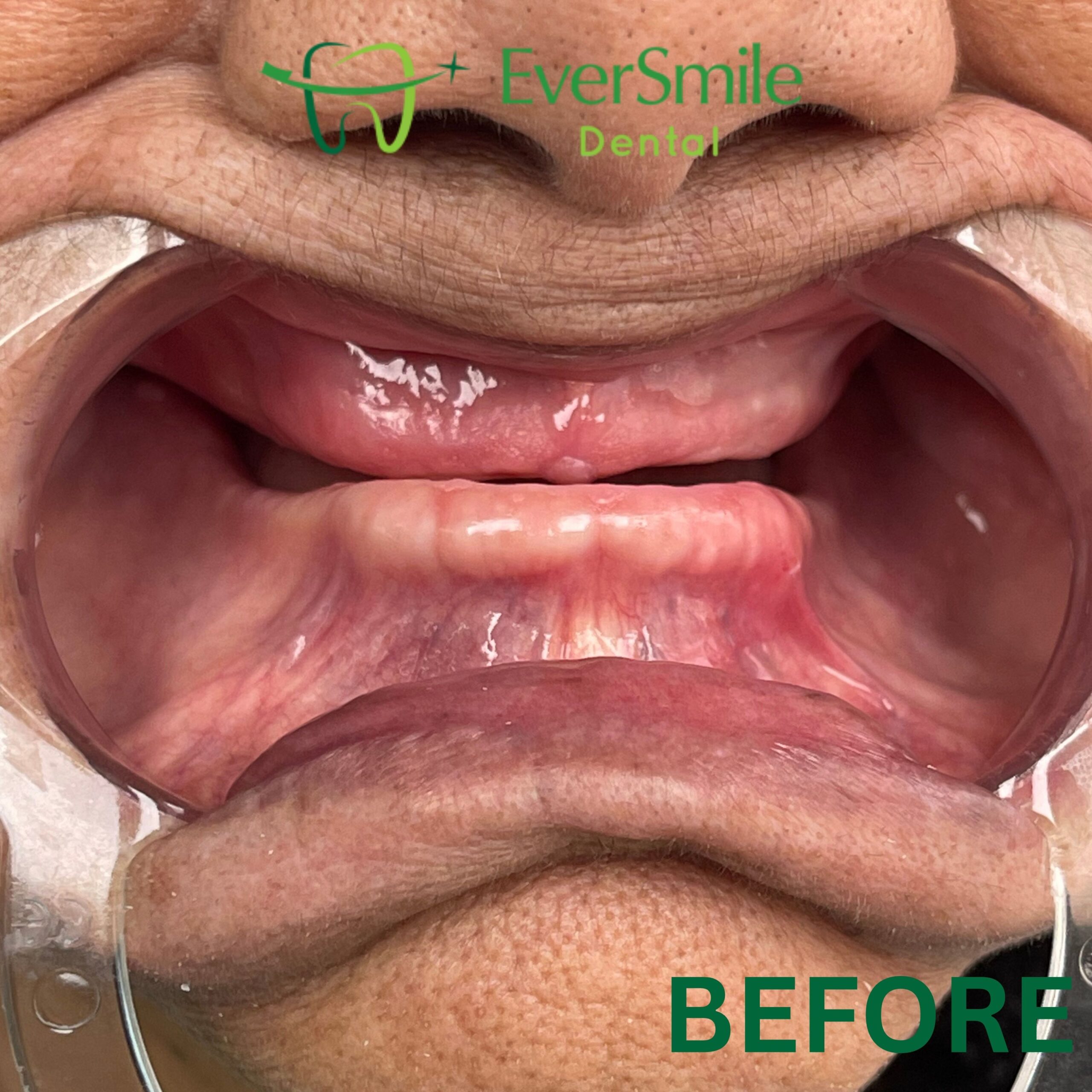 DENTURES BEFORE SLIDER SCALED