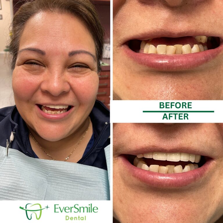 DENTAL BRIDGES 1 SMILING PATIENT AT EVERSMILE DENTAL WITH BEFORE AND AFTER PHOTOS SHOWING MISSING AND GAPPED FRONT TEETH RESTORED WITH A DENTAL BRIDGE