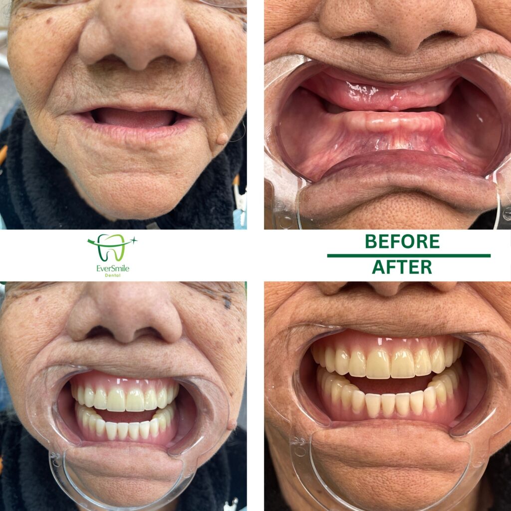 SMILE GALLERY 21 BEFORE AND AFTER PHOTOS OF PATIENT WITH NO TEETH RESTORED WITH FULL DENTURES AT EVERSMILE DENTAL, SHOWN IN CLOSE-UP AND FULL SMILE