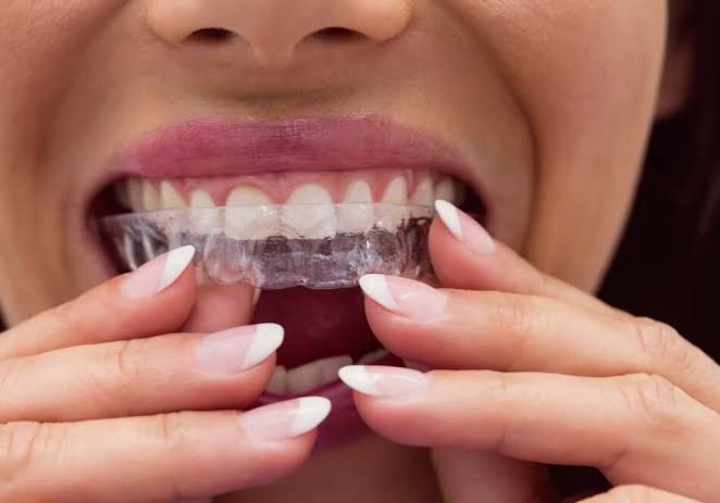 RETAINERS 1 DENTAL RETAINER APPLIANCE - EVERSMILE DENTAL NJ