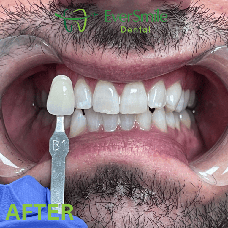 TEETH WHITENING AFTER TREATMENT - EVERSMILE DENTAL NJ
