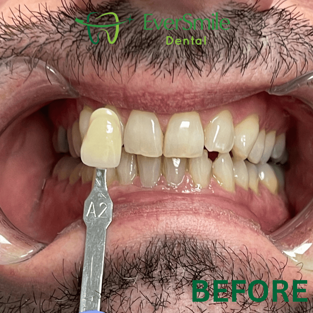 TEETH WHITENING BEFORE TREATMENT - EVERSMILE DENTAL NJ