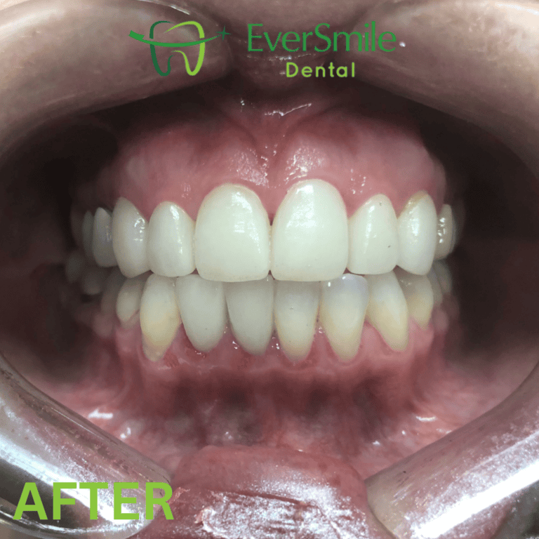 VENEERS AFTER TREATMENT - EVERSMILE DENTAL NJ