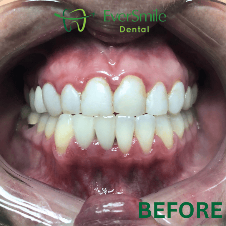 VENEERS BEFORE TREATMENT - EVERSMILE DENTAL NJ