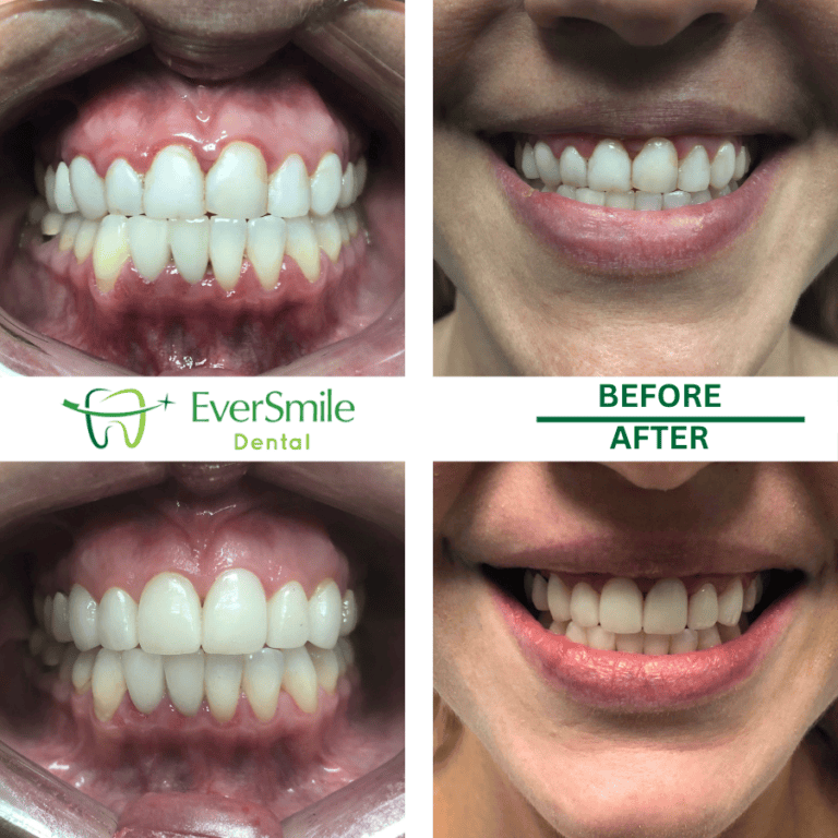 VENEERS 1 VENEERS BEFORE AND AFTER RESULTS - EVERSMILE DENTAL NJ