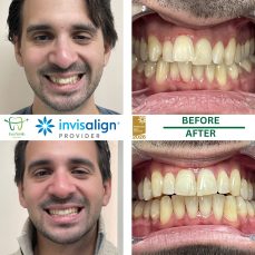HOME 9 INVISALIGN BEFORE AND AFTER RESULTS - EVERSMILE DENTAL NJ