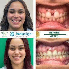 HOME 5 INVISALIGN BEFORE AND AFTER RESULTS - EVERSMILE DENTAL NJ