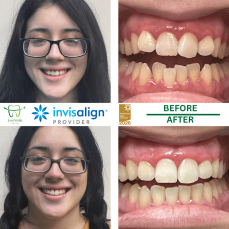 HOME 10 INVISALIGN BEFORE AND AFTER RESULTS - EVERSMILE DENTAL NJ