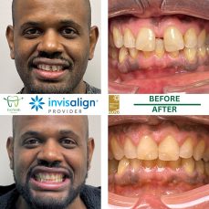 HOME 8 INVISALIGN BEFORE AND AFTER RESULTS - EVERSMILE DENTAL NJ