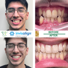 HOME 7 INVISALIGN BEFORE AND AFTER RESULTS - EVERSMILE DENTAL NJ