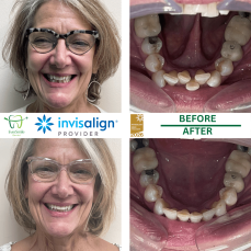 HOME 6 INVISALIGN BEFORE AND AFTER RESULTS - EVERSMILE DENTAL NJ