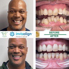 HOME 4 INVISALIGN BEFORE AND AFTER RESULTS - EVERSMILE DENTAL NJ